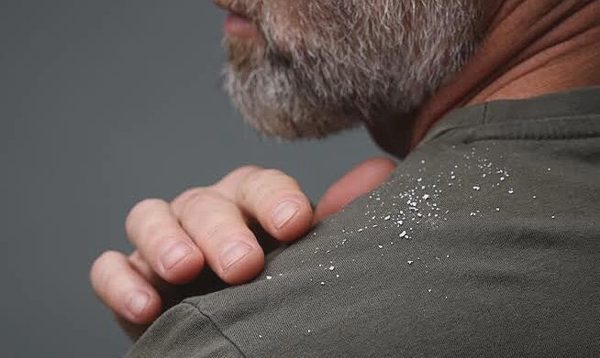 25 vảy gàu trên mặt nạ giúp cảnh sát phá vụ cướp sau 11 năm