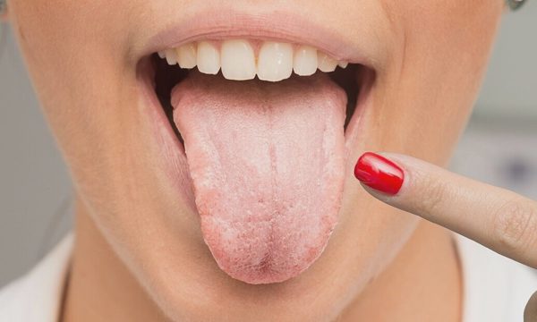 3 dấu hiệu trên lưỡi có thể tiết lộ sức khỏe mạch máu