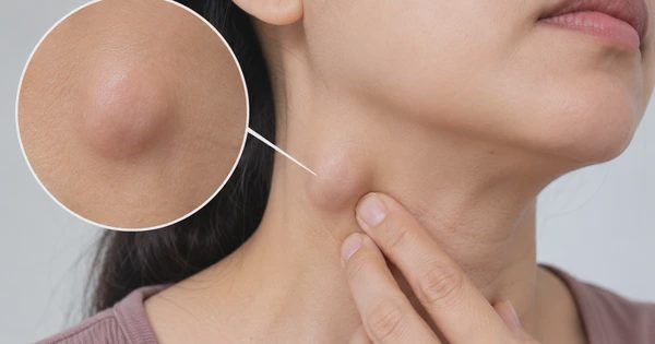 3 điều cần biết khi xuất hiện hạch ở cổ