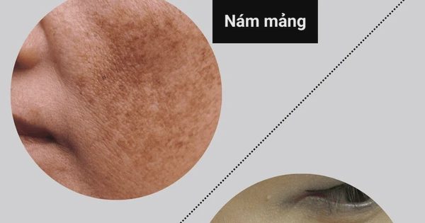 +3 kem mờ nám chân sâu sau khoảng 4 tuần khiến chị em không tin vào mắt