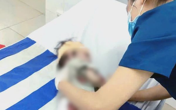 4 người đi xe máy bị cuốn vào gầm xe tải, bé gái 2 tuổi bị trầy xước, sức khỏe ổn định