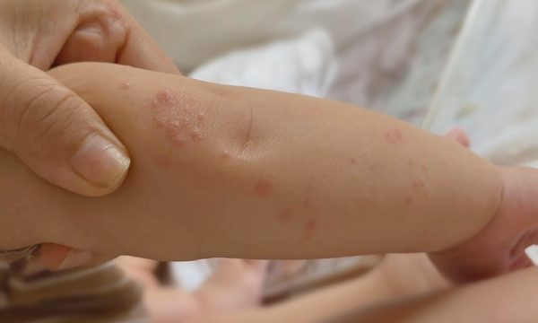 5 dấu hiệu dễ bị hiểu nhầm khi trẻ mắc tay chân miệng