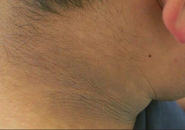 5 dấu hiệu tiểu đường ít được chú ý