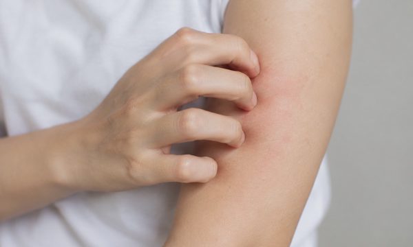 5 dấu hiệu trên da cảnh báo tổn thương thận