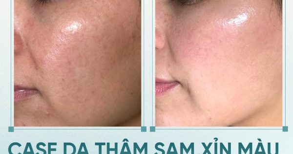 +5 serum mờ nám mảng, nám chân sâu; hiệu quả cả nám lâu năm không xâm lấn