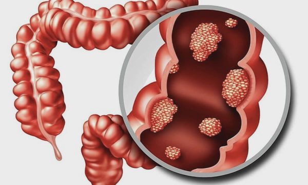 6 dấu hiệu ung thư ruột nhiều người tưởng 'rối loạn tiêu hóa'