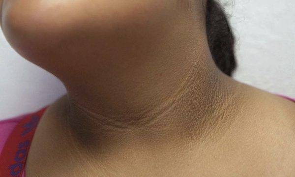 7 dấu hiệu trên khuôn mặt cảnh báo sớm bệnh tiểu đường
