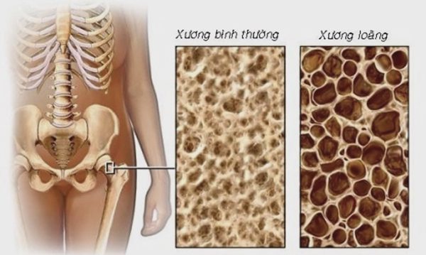 Ai cần đo loãng xương?