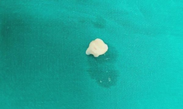 Bà nhổ răng sữa bằng chỉ, bé trai 7 tuổi hóc xẹp phổi
