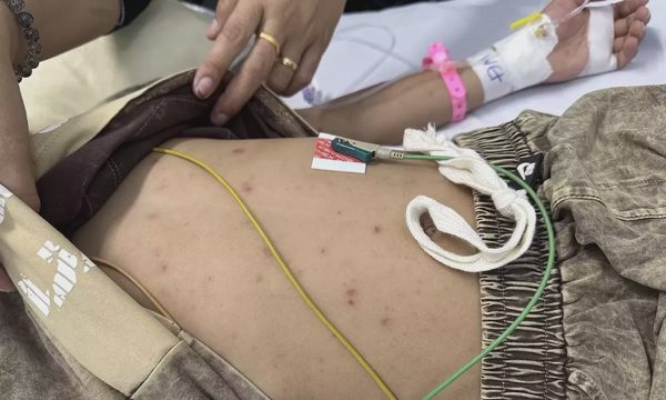 Bác sĩ cảnh báo dấu hiệu não mô cầu dễ bị bỏ sót