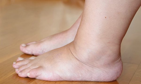 Bác sĩ Mỹ chỉ ra 5 dấu hiệu ở chân cảnh báo thận suy