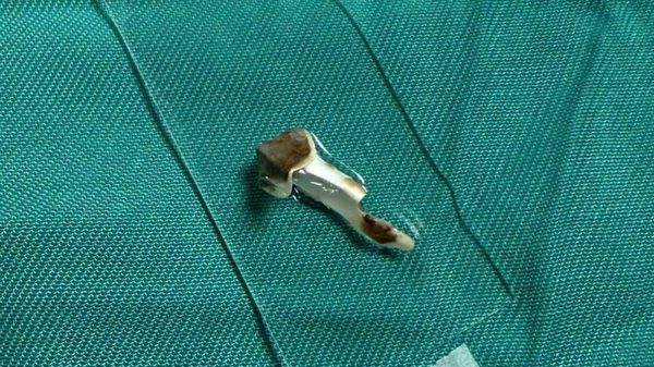 Bé 13 tuổi bị dị vật nhựa mắc kẹt trong phế quản suốt hơn 3 năm