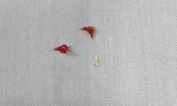 Bé 7 tháng tuổi phải thở máy vì xương lươn găm sâu đường thở