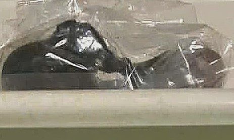 Bé gái 5 tuổi tắc ruột bởi khối tóc gần 250 gram