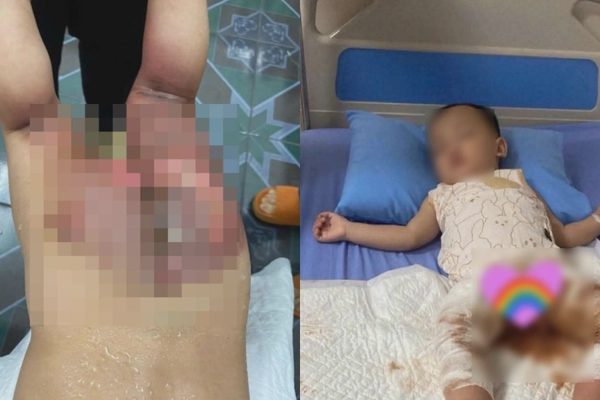 Bé hơn 1 tuổi bị bỏng nặng ở trường, gia đình đề nghị làm rõ