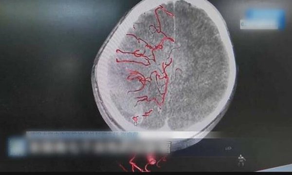 Bé trai 10 tuổi liệt nửa người sau khi tự nhổ răng sâu