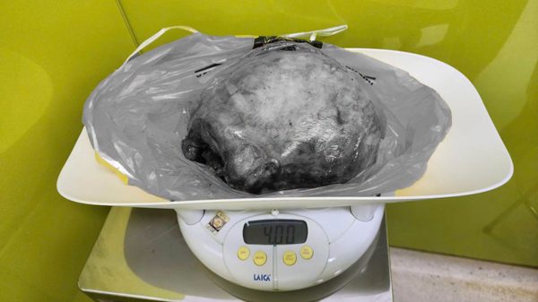 Bé trai chào đời an toàn dù mẹ mang khối u xơ tử cung 4kg