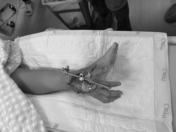 Bé trai lớp 3 bị cổng đè đứt tay: Hàng trăm người sẵn sàng hiến máu