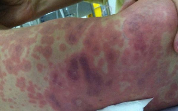 Bệnh não mô cầu, đừng chờ nổi ban mới đi viện