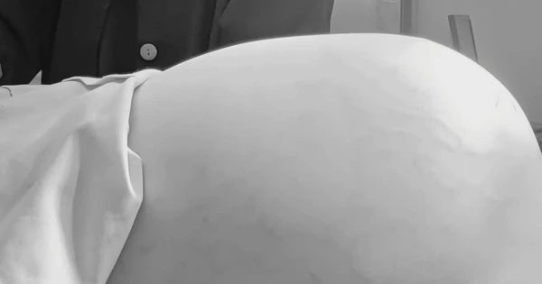 Bệnh viện Nhi đồng 1 TP.HCM mổ bướu buồng trứng 15 kg ở bé gái 14 tuổi