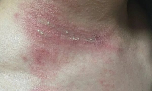 Bị kiến ba khoang cắn có nên tiêm vaccine?