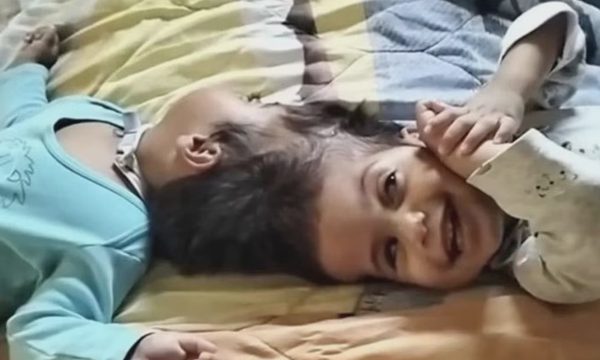 Biến cố phút chót khiến cặp song sinh dính đầu qua đời trên bàn mổ