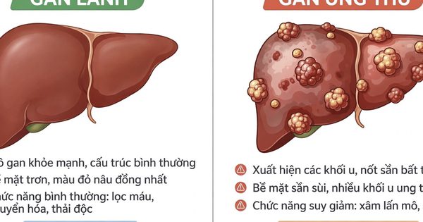 Biến đổi về màu da, nước tiểu cảnh báo ung thư gan
