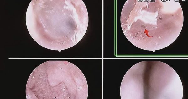 Bọ chét 'làm tổ' trên người: Dấu hiệu và cách phòng tránh