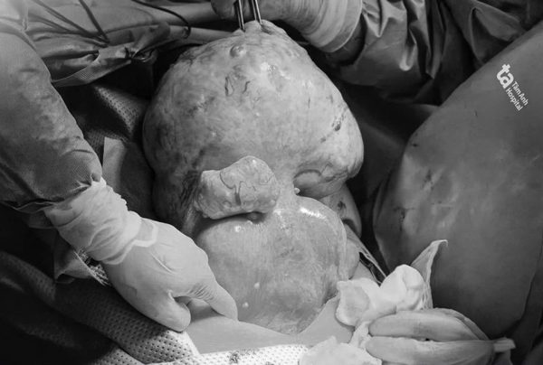 Bóc 25 khối u nặng gần 4,5 kg, giữ tử cung cho người phụ nữ 40 tuổi