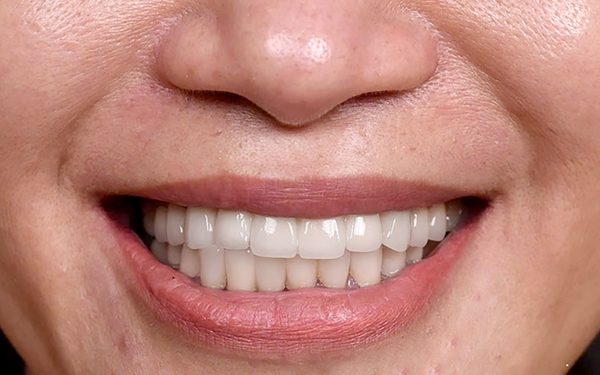 Bọc răng sứ tràn lan, bác sĩ cảnh báo nguy cơ can thiệp quá mức