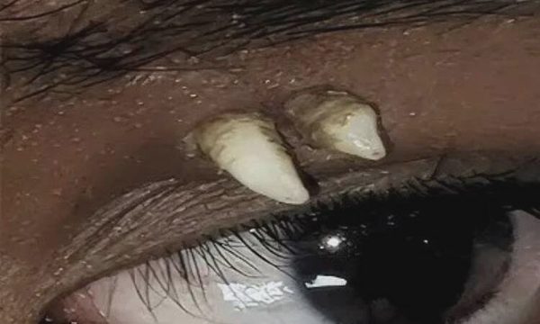 Ca răng mọc trong hốc mắt lần đầu xuất hiện trong y văn thế giới