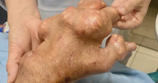 Các thực phẩm giúp kiểm soát axít uric ở người bệnh gout
