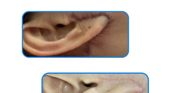 Cách làm mờ sẹo vết thương: Sẹo mới phải chờ? Không, đây mới là 'thời điểm vàng'