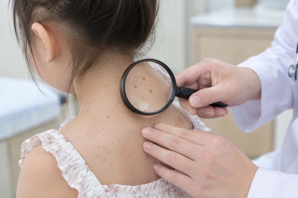 Căn bệnh khiến ánh nắng trở thành 'kẻ thù', nguy cơ ung thư tăng gấp nghìn lần