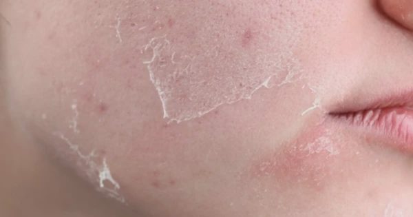 Càng rửa mặt da càng khô, xỉn màu: Có phải bạn mắc 5 sai lầm dưới đây?