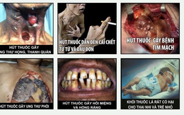 Cảnh báo sức khỏe trên bao thuốc lá đang giảm sự chú ý, chuyên gia đề nghị thay đổi ra sao?