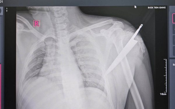 Cấp cứu thành công cho nam thanh niên bị dao cắm sâu vào bả vai
