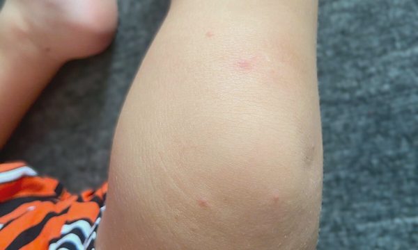 Chia nhau nghỉ làm chăm con tái nhiễm tay chân miệng