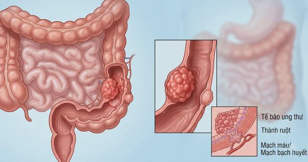 Chủ động làm xét nghiệm này, nguy cơ tử vong do ung thư giảm 43%