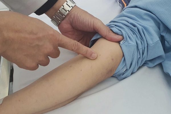 Chùm 4 ca não mô cầu tại TPHCM: Lập danh sách người tiếp xúc gần