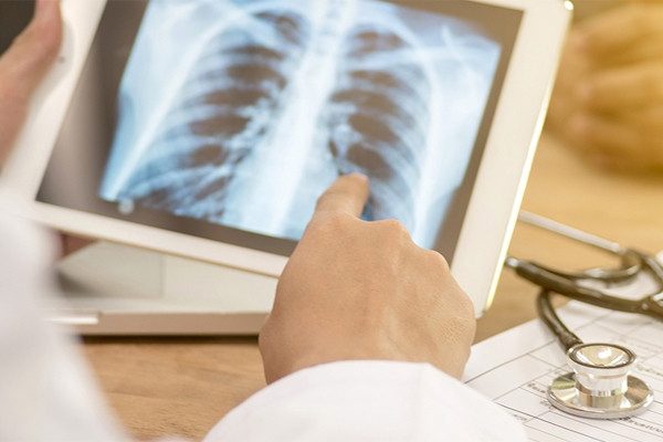 Chuyên gia BV Bạch Mai chỉ ra 4 tác nhân gây ung thư phổi dù không hút thuốc