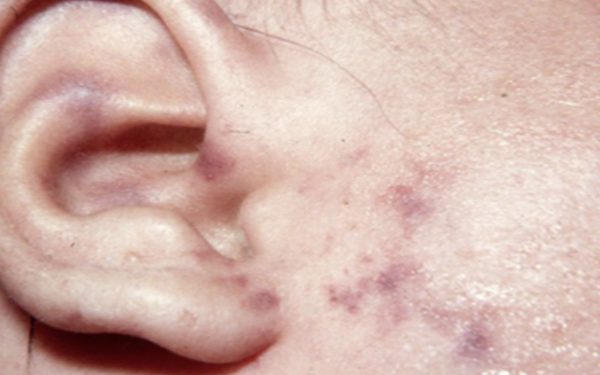 Chuyên gia lý giải vì sao bệnh do não mô cầu ít gặp, vẫn cần chủ động kiểm soát từ đầu
