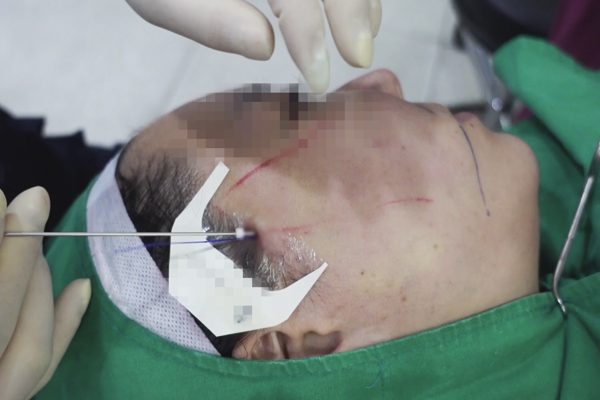 Cô gái 23 tuổi được tư vấn căng da mặt sau 4 lần phẫu thuật thẩm mỹ