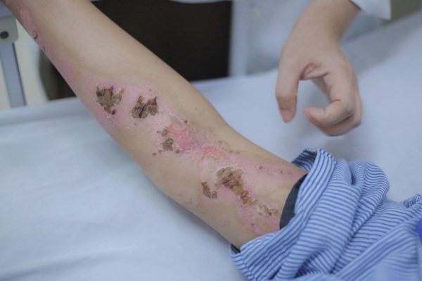 Cô gái gục xuống giữa cánh đồng sau cú sét đánh