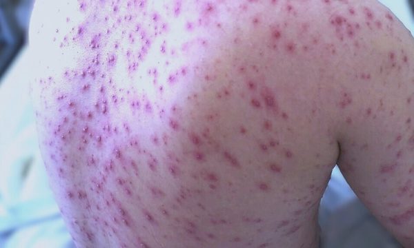 Có phải mụn nước thủy đậu sẽ mọc tới 500 nốt?