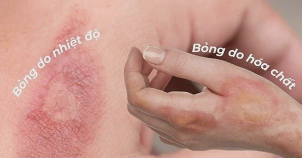 Cứ nghĩ sẹo bỏng phải xâm lấn nhưng dùng kem mờ sẹo vẫn hiệu quả nhanh chóng
