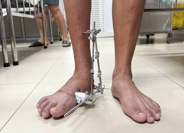 ‘Cứu’ bàn chân biến dạng suốt 21 năm cho chàng trai trẻ