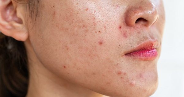 Da dầu mụn cứ skincare là bít tắc: Bạn có đang bỏ quên bước quan trọng này?