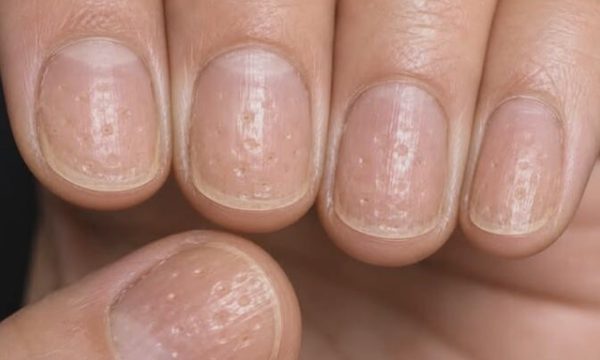 Dấu hiệu bất thường trên móng tay cảnh báo bệnh tiềm ẩn