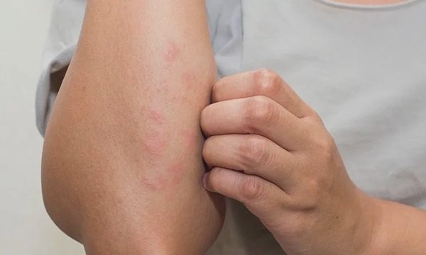 Dấu hiệu thay đổi trên da cảnh báo tiểu đường